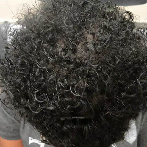 gilbertmedspa - Before Treatment